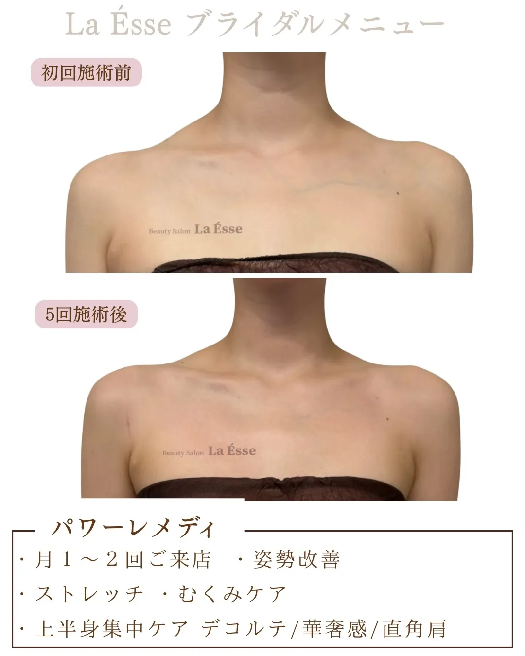 もりっとした肩から卒業！自信が持てるデコルテへ👰🏻‍♀️✨