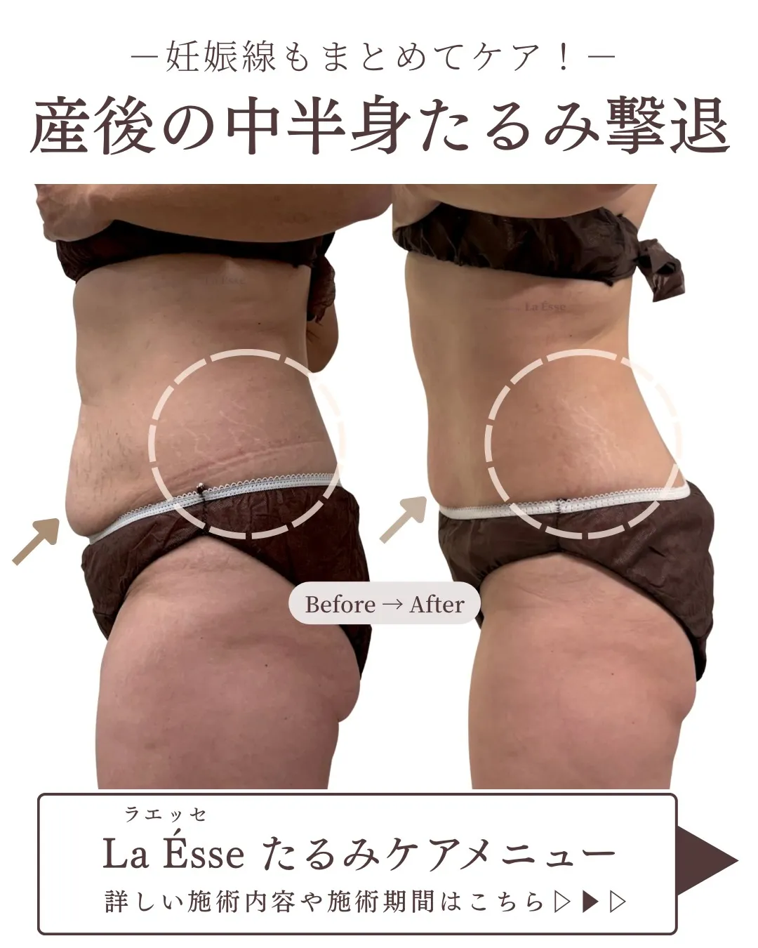⁡【産後のお腹】皮膚のたるみも妊娠線も同時にケア◎