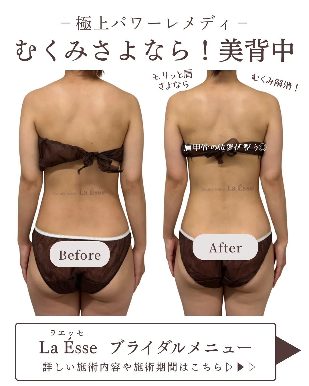 極上筋膜リリース