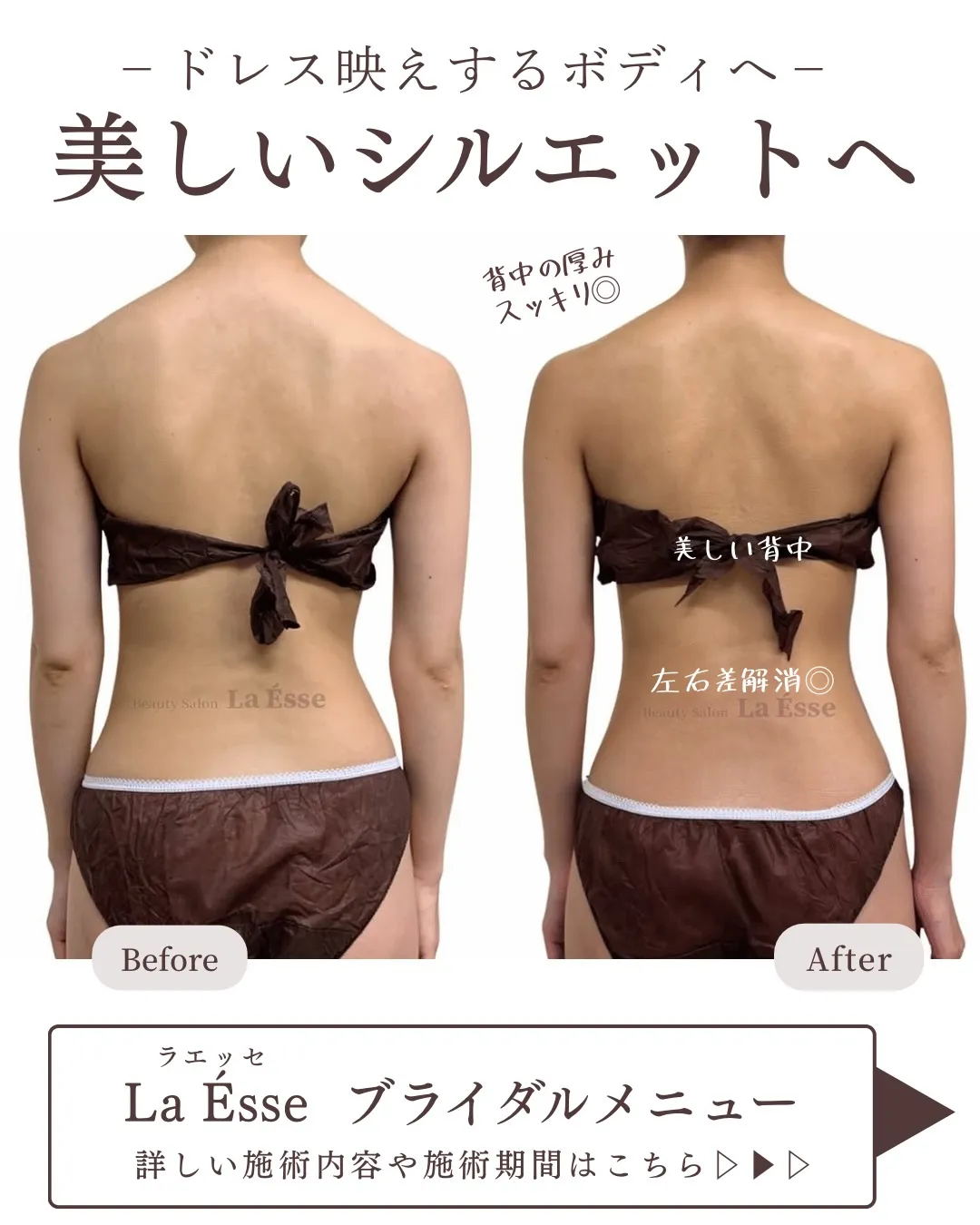 背中のモリっと感解消！スッキリした後ろ姿へ👰🏻‍♀️🩵