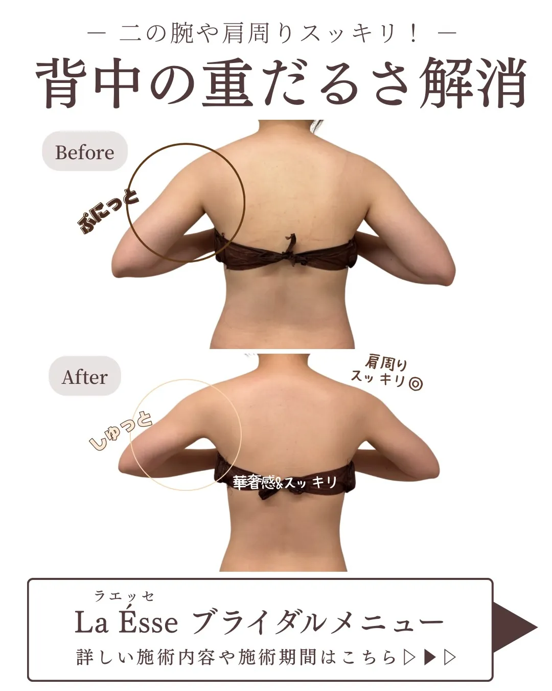 ボトックス💉をしなくても肩は美しく変わる🤝🏻✨