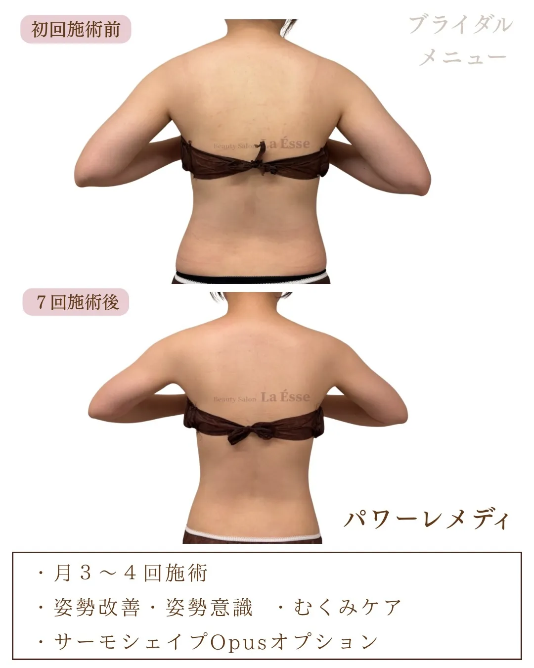 ボトックス💉をしなくても肩は美しく変わる🤝🏻✨