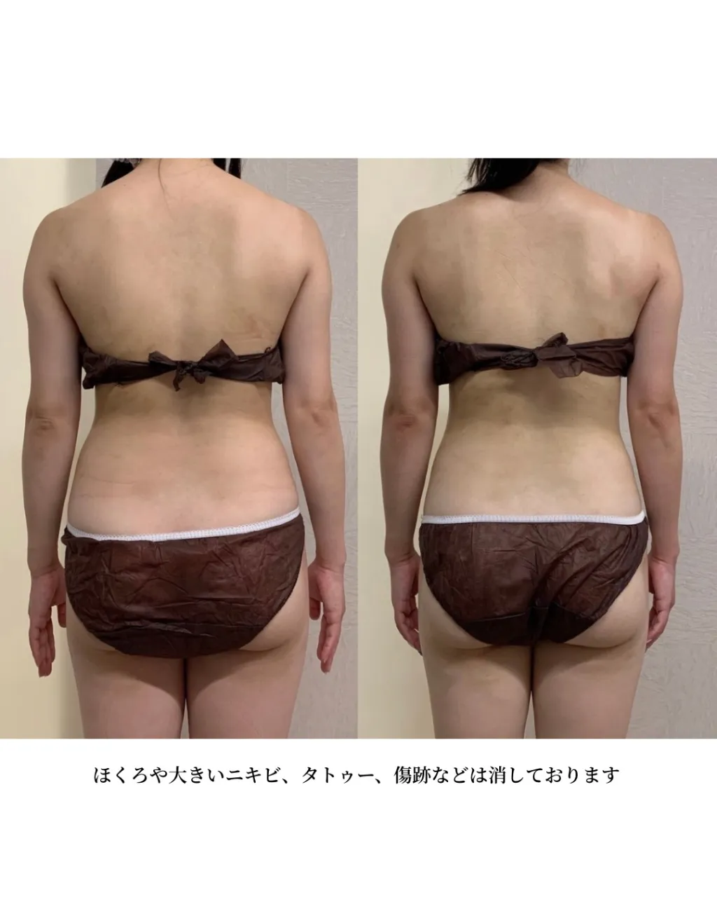 ３回筋膜リリースでなで肩から卒業へ✨ 背中スッキリ‼️